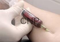 Medical professional wearing gloves drawing blood from a patient's arm with a syringe (blood draw). If context is a clinical setting, this indicates a blood sample collection.